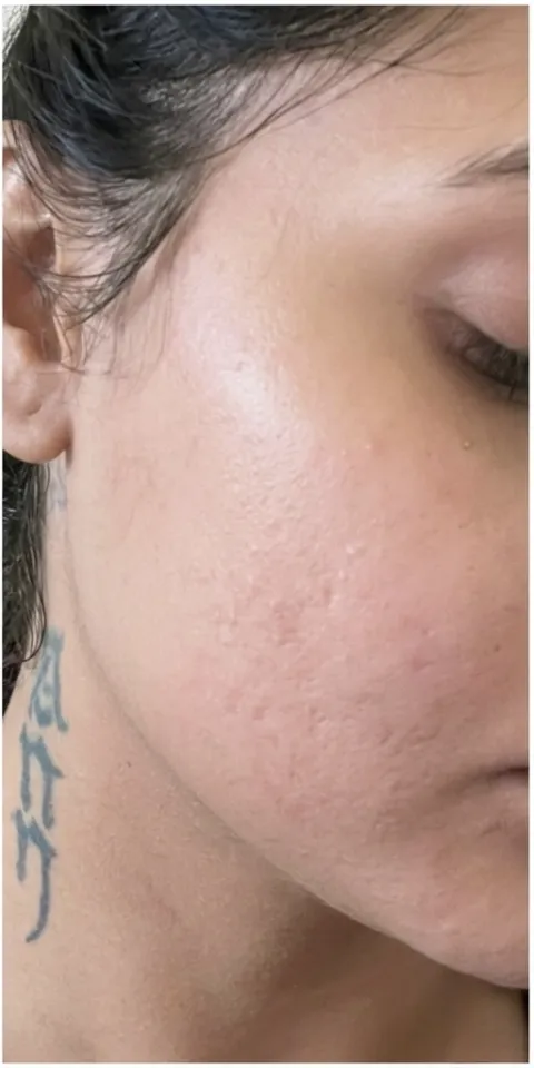 Acne & Texture: after