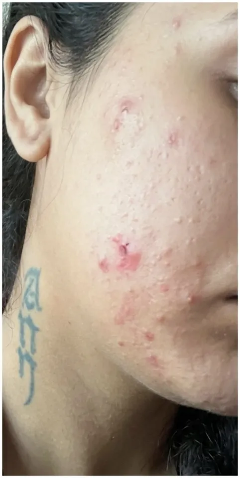 Acne & Texture: before